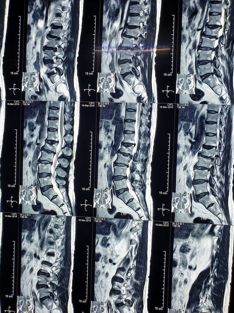 Thoát vị đĩa đệm chèn ép rễ thần kinh